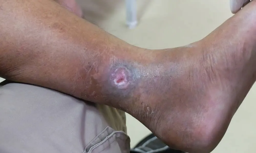 Bénin : le gouvernement lance une campagne de consultations foraines des personnes présentant des plaies ou ulcérations des jambes